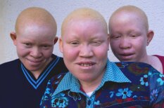 Albīni bērni no Tanzānijas, kuru miesa ir vērtīgāka par zeltu