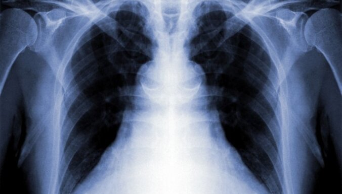 ЦКПЗ: в Латвии значительно сократилась заболеваемость туберкулезом