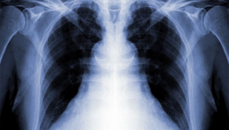 Ar tuberkulozi var inficēties jebkurš